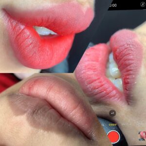 Tại sao phun môi bị sưng? Nguyên nhân thường gặp và cách xử lý an toàn