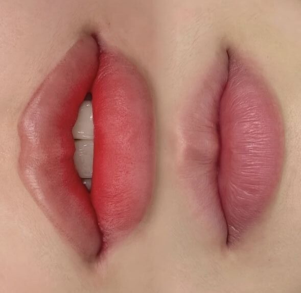 Phun môi collagen là gì? Bí quyết để có đôi môi căng mọng tự nhiên 1 Phun môi collagen là gì? Bí quyết để có đôi môi căng mọng tự nhiên