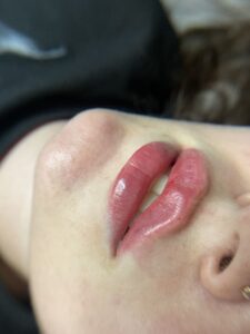 Ăn cay sau phun môi 5 Ăn cay sau phun môi — sự thật & myth hiểu sai phổ biến