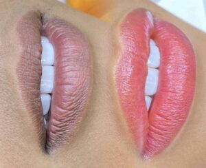 Khử thâm môi là gì? Giải pháp làm hồng môi an toàn trong phun xăm thẩm mỹ