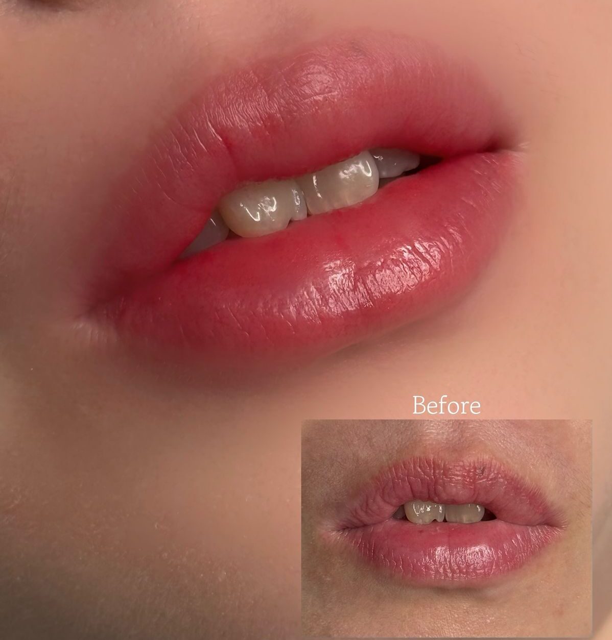 Phun môi xong ăn uống ngày đầu được không? 7 món “cần nhớ”