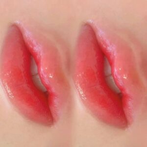 Có nên phun môi khi đang niềng răng / chỉnh nha không?