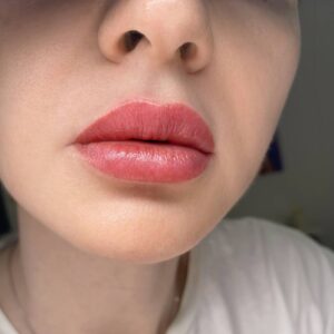 Phun môi bao lâu thì hết sưng hoàn toàn? Từng giai đoạn hồi phục