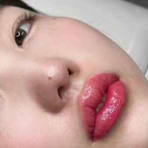 Phun môi xong có chạm tay vào được không? Lý do khoa học 3 Tuổi nào hợp nhất để đi phun môi? Có nên trước 18?