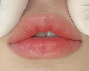 Phun môi cho môi mỏng: Khi nào giúp môi đầy đặn, khi nào phản tác dụng?