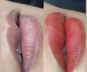 Phun môi đẹp hay không phụ thuộc vào cơ địa nhiều đến mức nào?