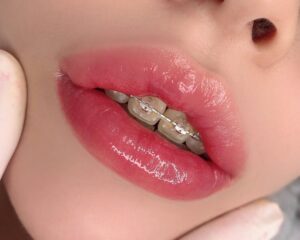 Có nên phun môi khi đang niềng răng? Chuyên gia phân tích 2 Phun môi một lần hay phải làm lại nhiều lần mới đẹp?