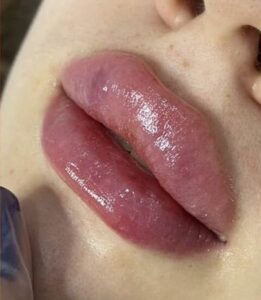 Những dấu hiệu cho thấy ca phun môi không đạt kết quả như mong đợi