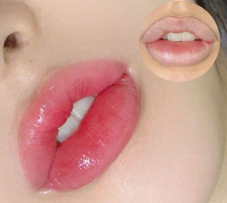 Phun môi collagen là gì? Bí quyết để có đôi môi căng mọng tự nhiên 2 Bí quyết chọn phun môi theo kiểu dáng môi – Đầy đặn hay tự nhiên?