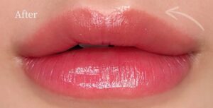 Phun môi có làm môi “lười” tái tạo tế bào không?