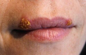 Bị mụn nước sau phun môi: Khi nào để lại sẹo, khi nào không?