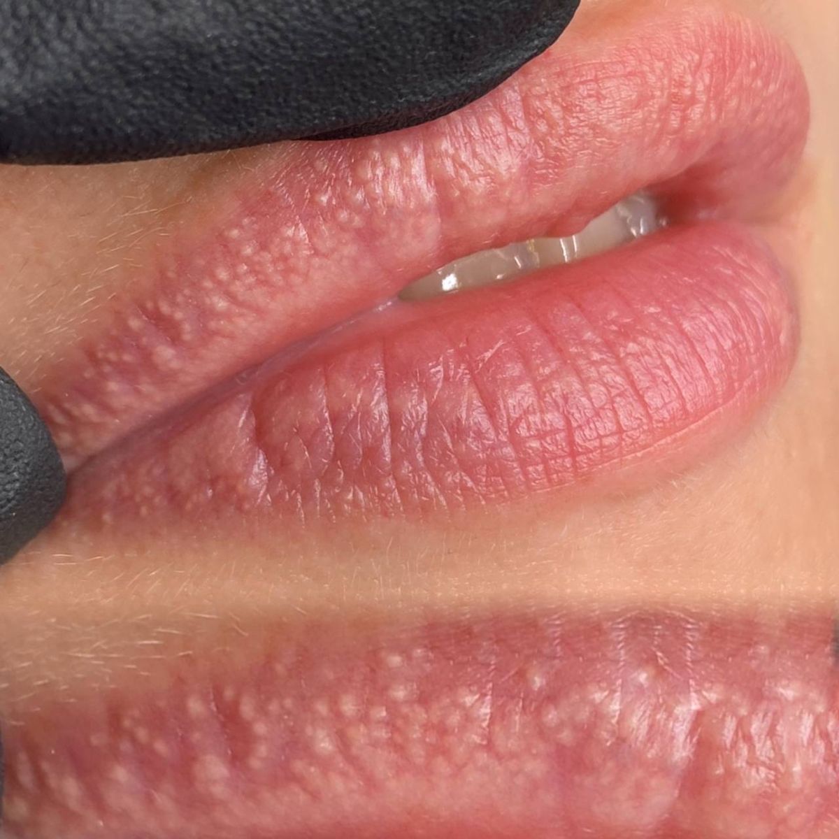 Các vấn đề thường gặp sau phun môi & cách xử lý an toàn