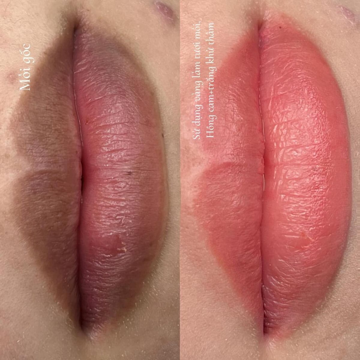 Có nên khử thâm môi trước khi phun môi không?