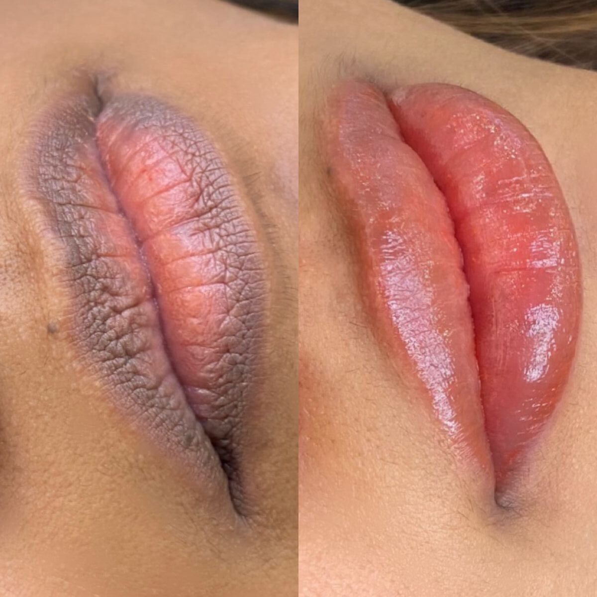 Phun môi thâm: Nguyên nhân, lộ trình xử lý & sai lầm cần tránh 2 Khu tham moi la gi 1 e1769487282383