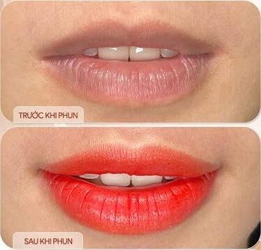 Khử thâm môi công nghệ mới – An toàn, không đau 2 Khử thâm môi là gì? Giải pháp giúp môi hồng hào tự nhiên
