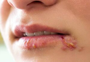 Vừa phun môi xong nên bôi gì để tránh nhiễm trùng và khô môi?