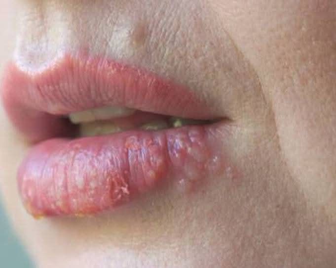 Mụn nước sau phun môi có nguy hiểm không? Có để lại sẹo hay thâm?