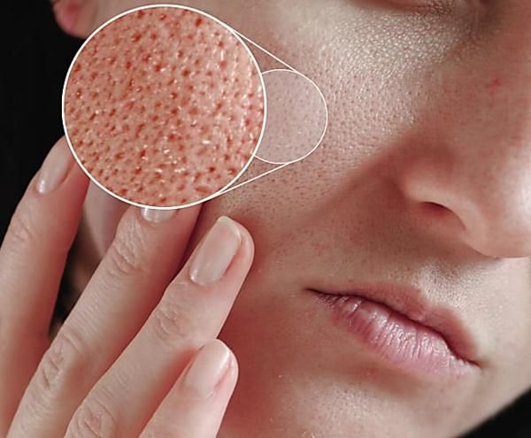 Phun chân mày chạm hạt có phù hợp với da dầu và lỗ chân lông to không?