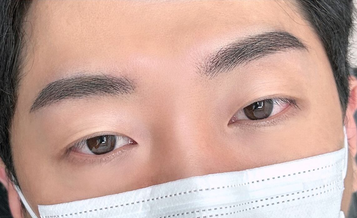 Phun chân mày nam sau bong có bị đậm không? Giai đoạn nào là chuẩn nhất?