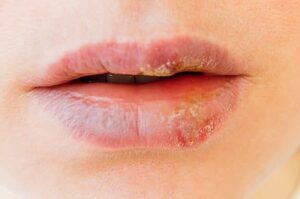 Phun môi bị mụn nước bao lâu thì hết? Dấu hiệu bình thường hay biến chứng?