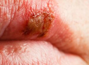 Phun môi bị mụn nước và nguy cơ để lại sẹo – Chuyên gia phân tích