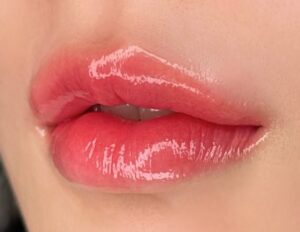 Phun môi bị sưng bao lâu thì hết? Khi nào cần đi khám ngay?