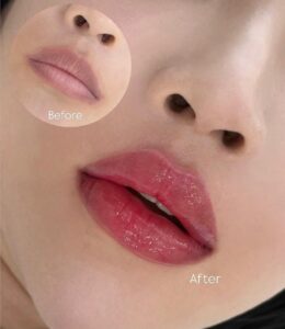 Phun môi pha lê có phù hợp với môi thâm không? Ai nên và không nên làm