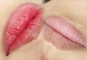 Phun môi sau 1 tháng bị thâm: Nguyên nhân và cách xử lý hiệu quả