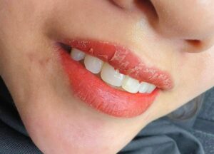 Quy trình phun môi chuẩn y khoa: Các bước an toàn quyết định màu môi đẹp