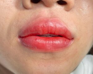 Sau phun môi bao lâu thì sinh hoạt bình thường? Những mốc thời gian cần biết