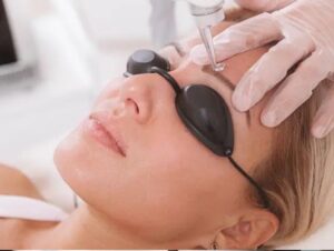 Sửa mày phun hỏng có cần xóa laser không?