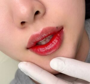 Phun môi có hại răng miệng không? Bác sĩ nói gì?