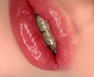 Tại sao có người phun môi không sưng, có người lại sưng nhiều?