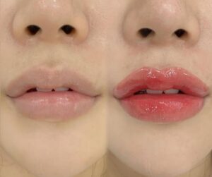 Điều gì xảy ra nếu phun môi khi đang ốm/viêm họng?