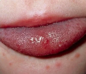 Phun môi xuất hiện mụn nước: phản ứng da hay dấu hiệu cần chú ý?