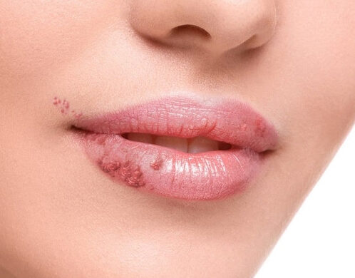 Những lỗi thường gặp sau khi phun xăm dịp Tết và cách khắc phục 3 Phun môi có để lại sẹo không? Sự thật bạn cần biết