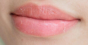 chế độ ăn giúp môi phun phục hồi nhanh