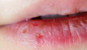 Phun môi xuất hiện mụn nước: cảnh báo gì cho sức khỏe môi?