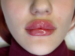 Phun môi xong bị sưng – đau – chảy dịch: Bình thường hay bất thường?