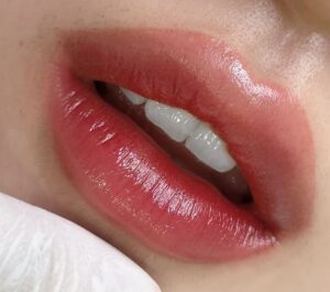 Cơ địa nào phun môi dễ bị thâm trở lại? Test nhanh trước khi quyết định làm