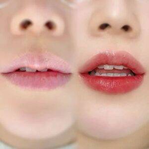 Phun môi collagen và phun môi tế bào gốc khác nhau thật hay chỉ khác tên gọi?