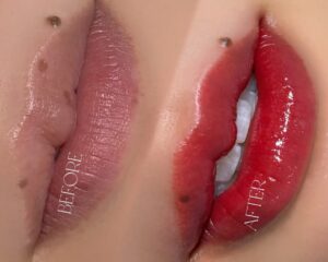 Môi thâm do son lì lâu năm có phun một lần là hết không?