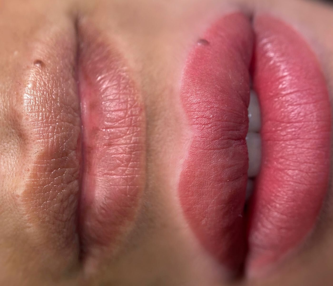 Khử thâm môi bao nhiêu lần thì hết? Lộ trình chuẩn từ chuyên gia