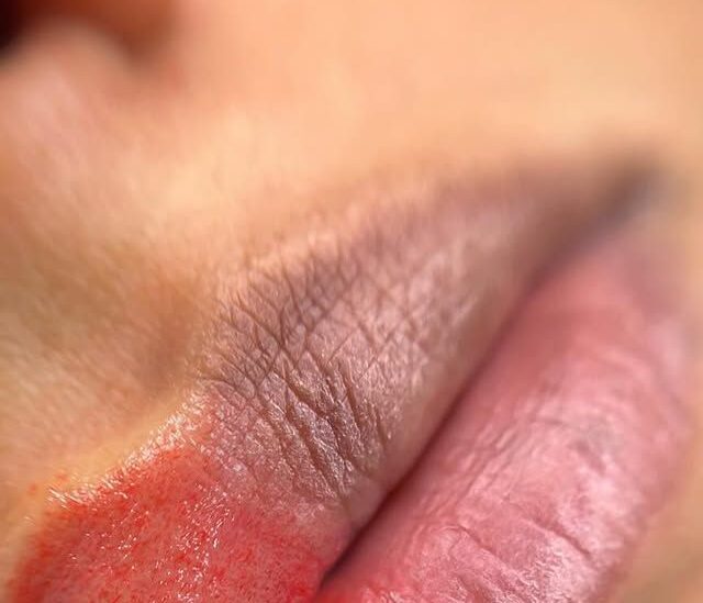 Phun môi thâm: Nguyên nhân, lộ trình xử lý & sai lầm cần tránh 1 Phun môi thâm: Nguyên nhân, lộ trình xử lý & sai lầm cần tránh