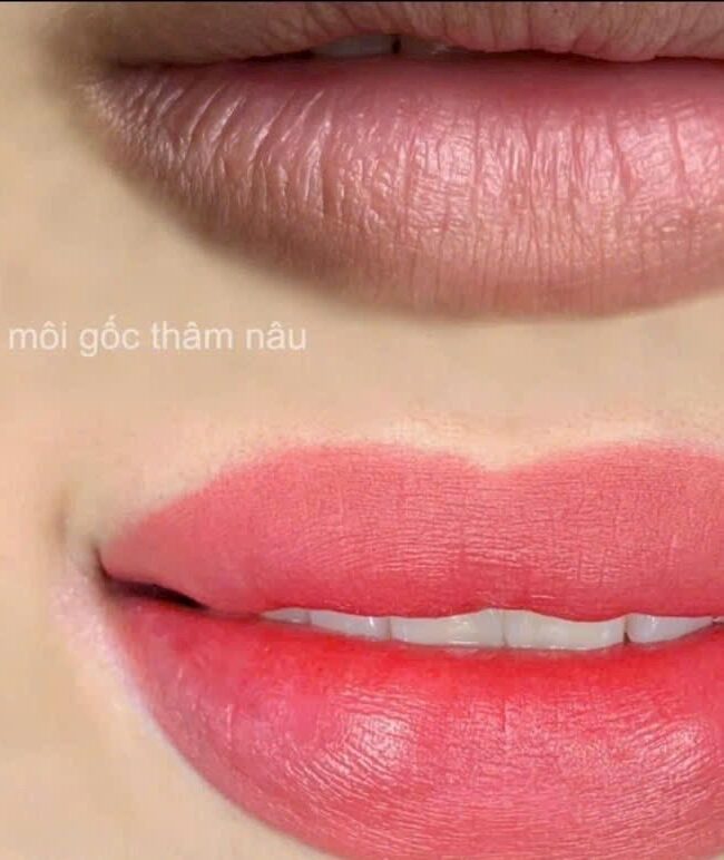 Khử thâm môi bằng công nghệ mới có hiệu quả không? Lộ trình và chi phí chi tiết