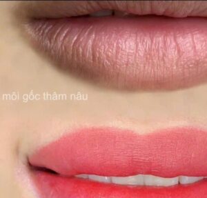 Khử thâm môi bằng công nghệ mới có hiệu quả không? Lộ trình và chi phí chi tiết